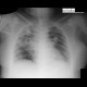 Aspergilosis of the lung: X-ray - Plain radiograph
